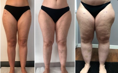 Vascular em Atibaia - Clínica JCG Tratamento do Lipedema, Clínica de Tratamento de Lipedema em Atibaia