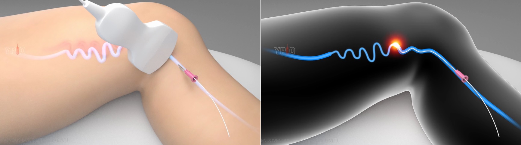 Vascular em Atibaia - Clínica JCG Tratamentos com Endolaser para Safena, Laser Transdérmico Atibaia