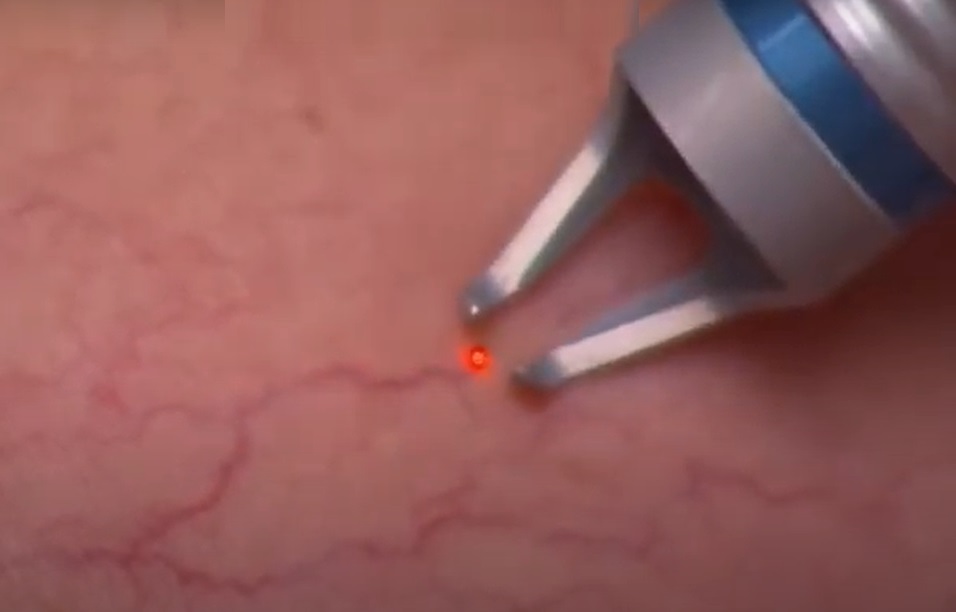 Vascular em Atibaia - Clínica JCG Tratamentos com Laser Transdérmico para Vasinhos em Atibaia