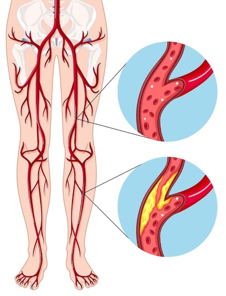 Vascular em Atibaia - Clínica JCG Tratamentos da Doença Arterial Obstrutiva Periférica DAOP Atibaia