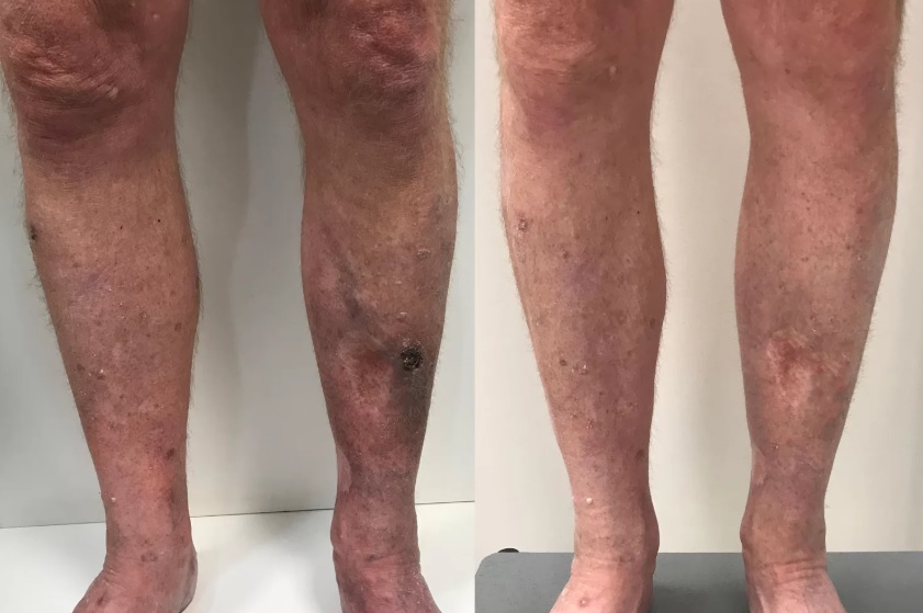 Vascular em Atibaia - Clínica JCG Tratamentos de úlceras varicosas e úlceras arteriais em Atibaia
