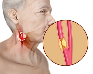 Vascular em Atibaia - Clínica JCG Clínica de Tratamentos da Estenose da Carótida em Atibaia