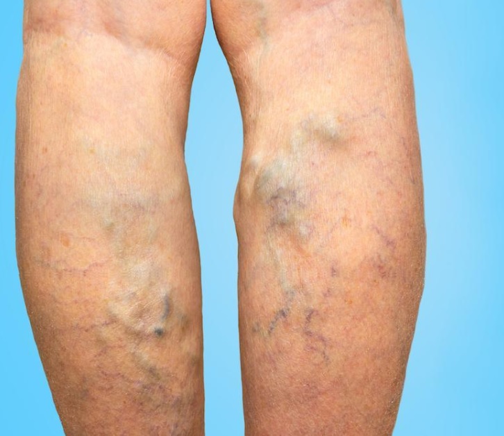 Vascular em Atibaia - Clínica JCG Tratamentos para Varizes, Clínica para Tratamentos para Varizes em Atibaia