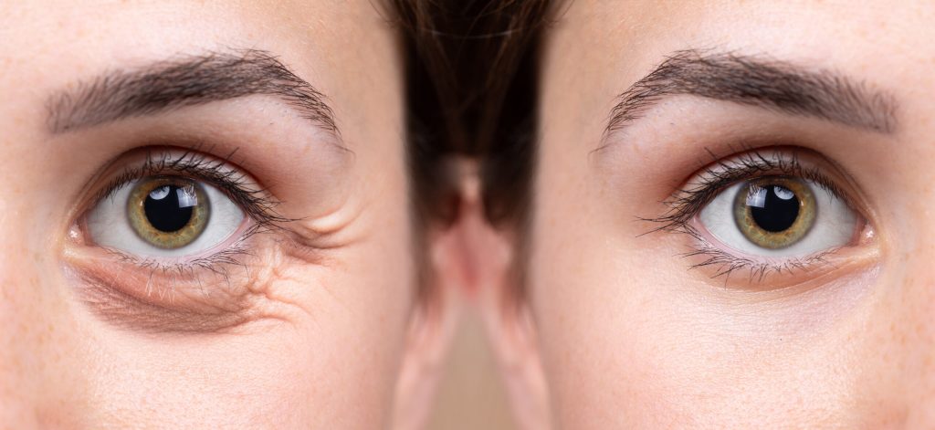 Vascular em Atibaia - Clínica JCG Blefaroplastia em Atibaia