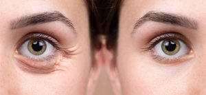 Vascular em Atibaia - Clínica JCG Blefaroplastia em Atibaia